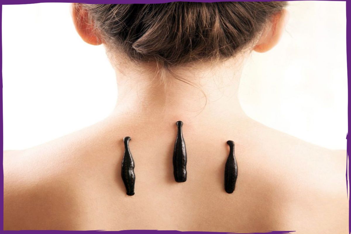 sülük tedavisi , ankara sülük tedavisi